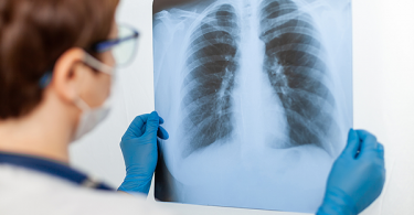 Doctor holding x-ray of lungs